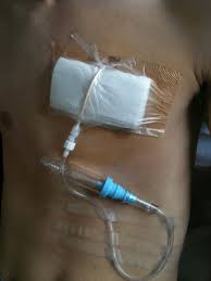 Image result for Small Caliber Chest Tube