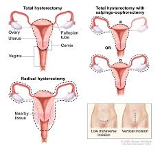 However, we do know that a woman with certain risk factors may be more likely than other women to develop cervical cancer. Vaginal Cancer Facts Symptoms Information Dana Farber Cancer Institute Boston Ma