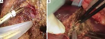 The position of each single marker was. Comprehensive Evaluation Of Liver Resection Procedures Surgical Mind Development Through Cognitive Task Analysis Ho Journal Of Visualized Surgery