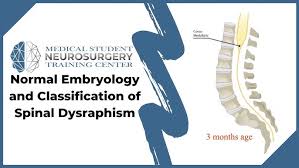 Image result for Spinal Dysraphism