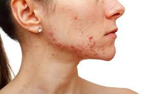 Mental illness isn't the fault of the person diagnosed. 4 Mental Illnesses That Could Cause Acne Thehealthsite Com