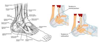 The difference between ligaments and tendons lies simply in the type of elements they connect and they are found only in the leg. Peroneal Tendon Dislocation Dysfunction Vascular Health Clinics