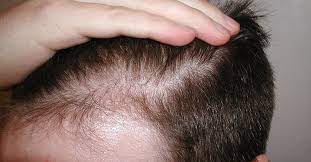 Ma la caduta dei capelli in giovane età può avere anche per altre cause. Il Diradamento Dei Capelli I Capelli Diradati Possono Ricrescere