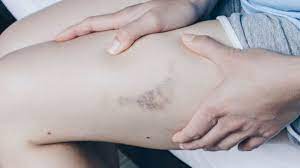Darum Bekommen Frauen Leichter Blaue Flecke