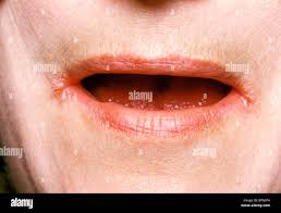 Image result for Angular Stomatitis