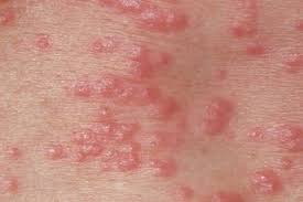 Image result for scabies human children