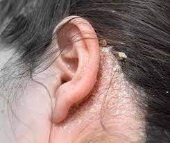Jul 01, 2020 · in besonders schlimmen fällen können sich die schuppenden, juckenden hautstellen über den ganzen körper des kindes ausbreiten. Schuppenflechte Auf Der Kopfhaut Psoriasis Info
