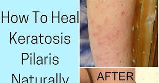 Chances Are If You Made It Here You Have Tried Other Things To Try And Heal Your Keratosis Keratosis Pilaris Keratosis Pilaris Diet Keratosis Pilaris Treatment