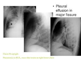 It is important to place the side of the effusion down. Ppt Pleural Effusion In Major Fissure Powerpoint Presentation Free Download Id 5306704