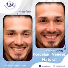 Veneer Gigi Porcelain Audy Dental