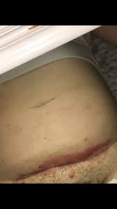 Pelvic floor physical therapists can help! Tmi But I Think My C Section Incision Is Infected Babycentre