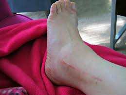 Broken Ankle Recovery Learning To Walk Again Lynda Makara