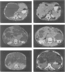 Suggested Classification Of Patients With Adult Polycystic Liver Download Scientific Diagram