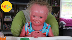 • nonmodifiable risk factors for atherosclerosis: My Friend With Harlequin Ichthyosis Skin That Grows Too Fast Youtube