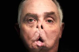 Fundraiser by Maurice Desjardins : Canadian Face Transplant Greffe Visage  Canadienne