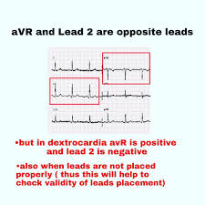 Image result for Electrocardiogram Validity