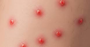 Image result for flea bite