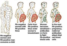 Image result for Rh Sensitization