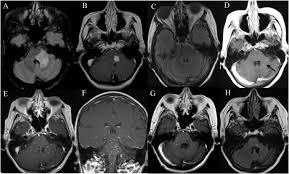 Chronic lymphocytic inflammation with pontine perivascular enhancement responsive to steroids (clippers) is a rare central nervous system inflammatory disease characterized by the punctate gadolinium enhancement peppering the pons and the cerebellar peduncles as neuroimaging. Mri Evolution Of Clippers Syndrome Following Herpes Zoster Infection Journal Of The Neurological Sciences