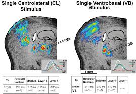 Image result for Thalamic Stimulation
