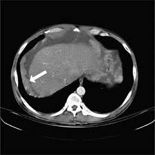 Peritoneal mesothelioma is usually a rapidly fatal primary peritoneal surface malignancy with a median survival time of less than 1 year, mainly because of . Diffuse Malignant Peritoneal Mesothelioma Sciencedirect