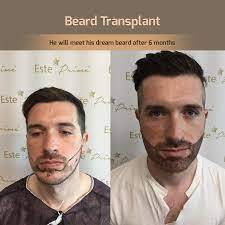 Restoring hair to the goatee, mustache, beard, and sideburns. Hair Transplant Cost In Turkey For People Who Want To Have A Hair By Hair Transplant Medium