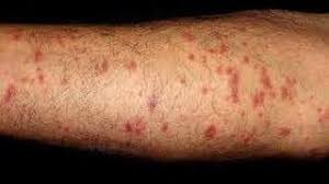 Algunos tipos se relacionan con mayor riesgo de cáncer. Tratamiento Para La Sarna Humana En Chile La Crema De Sarna Te Hace Picar