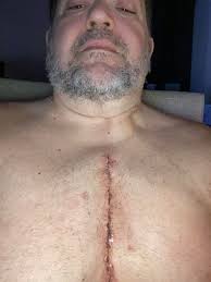 I had my ablation in august, I am back in afib continuously- my EP wants me  to get another ablation