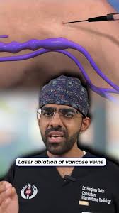 Non-Surgical Treatment for Varicose Veins