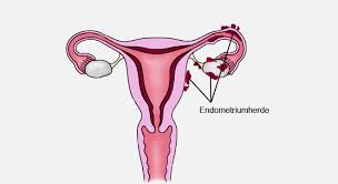 A endometriose é uma doença benigna, que se caracteriza pela proliferação do tecido chamado endométrio para fora da cavidade uterina, local em que ele normalmente se desenvolve. Endometriose