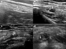We did not find results for: Sonographic Evaluation Of The Lateral Femoral Cutaneous Nerve In Meralgia Paresthetica Springerlink
