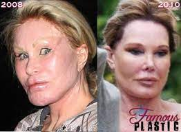 Celebrity Facelift Before N After Chirurgie Plastique Chirurgie