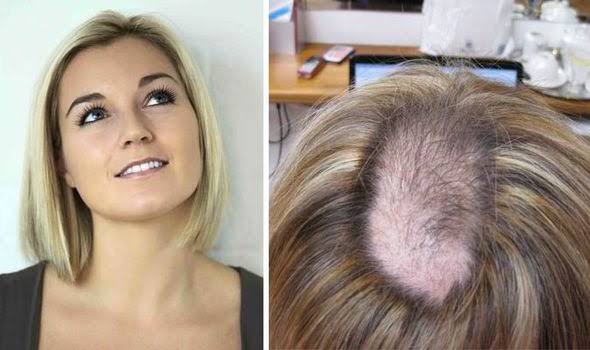 Mga resulta ng larawan para sa Trichotillomania sufferers pull hair"