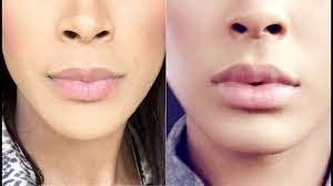 A provider on the east coast prices juvederm for smile lines (volbella xc) at $549 per syringe. 1 Syringe Of Juvederm Lip Fillers Before After Dr Eliot Battle Cultura Youtube