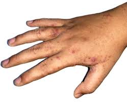Image result for scabies effects on the human body