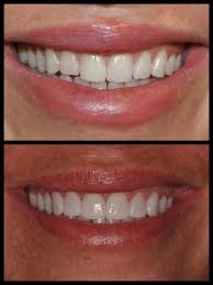 The onesmile plan is provided by discount medical. Smile Spotlight Charlene I Used To Hate My Smile Not Anymore