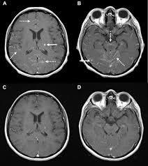 Cancer cells can move from the original site to anyplace in the body. Clinical And Radiographic Response Of Leptomeningeal And Brain Metastases To Encorafenib And Binimetinib In A Patient With Braf V600e Mutated Lung Adenocarcinoma Journal Of Thoracic Oncology