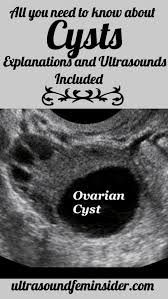 Ovaries Hormonal Cycles And Common Cysts In 2020 Ovarian Cyst Ovarian Cyst Symptoms Cyst On Ovary