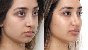 Even though cheek fillers aren't as common as, say, lip fillers, chances are you probably know someone who's gotten the procedure. Cheek Augmentation Before After Photos Dr Nima