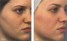 Yuzdeki Sivilce Izleri Nasil Gecer Sivilce Izi Yuzler Akne Tedavisi