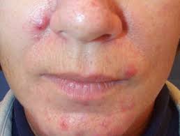 Frauen mit einem pcos haben wesentlich häufiger akne als der durchschnitt der bevölkerung in deutschland. Polyzystisches Ovarialsyndrom Dermatly Com Ihre Hautseite