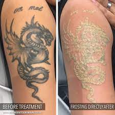 Choose the best tattoo removal in melbourne. Images Tailored Tattoo Removal Melbourne