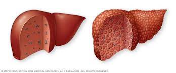 Can liver cancer be found early? Cirrhosis Symptoms And Causes Mayo Clinic