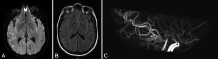 Democrats represent black america 'like plantation owners represented slaves'. Pregnancy After Direct Cerebral Bypass For Moyamoya Disease In Journal Of Neurosurgery Volume 134 Issue 1 2019