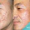 Pickel loswerden pickel hausmittel pickel soforthilfe pickel entfernen pickel tee home remedies for pimples how to remove pimples how to get rid of pimples. 1