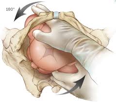 Image result for Manual Rotation in Occipitoposterior Presentation
