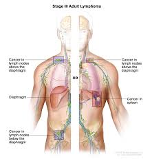 Neck lumps often relate to underlying enlarged lymph node(s) (known as lymphadenopathy). Hodgkin Lymphoma Hoa Hematology Oncology Associates Of Cny