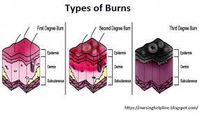 Burn Types Critical Care Nursing Pediatrics Burns