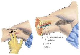 Image result for Axillary Nerve Block