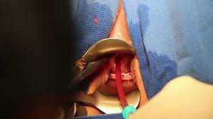 The process usually takes less than five minutes. Vaginal Iud Birth Control Insertion Surgery Youtube